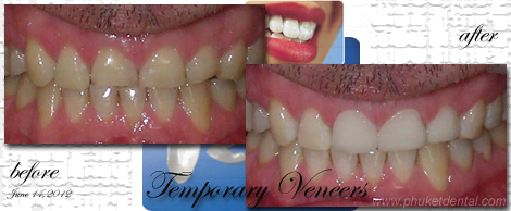 Temporary Crowns&Bridges at Phuket Dental Clinic,Thailand